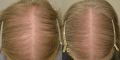 hair growth vitamins – DHT BLOCKER HAIR FORMULA – saw palmetto for hair loss 3B
